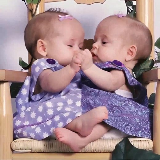👧👧 These Siamese twins were separated 18 years ago, and everyone believed they wouldn’t survive. 😢 Today, after years of struggle, they’ve proven that miracles are real. ✨ 📌 See how the sisters live now – the touching story is in the comments. 👇👇 Read more in Comment or Most relevant -> All comments 👇 | Simon TJG