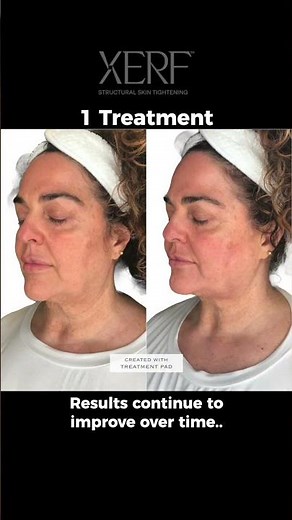 XERF Before & After Results | Non-Invasive Skin Tightening