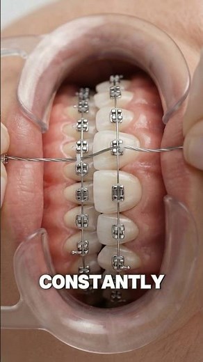 How Braces ACTUALLY Straighten Your Teeth 🦷 #shortsfeed