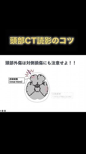 頭部外傷は対側損傷にも注意せよ【頭部CT読影のコツ】 #shorts
