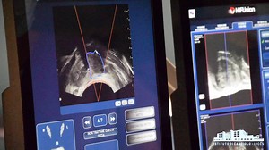 Un'arma in più presso l'Istituto di Candiolo per sconfiggere il carcinoma della prostata localizzato con il trattamento HIFU Focal One. Terapia chirurgica mini invasiva che con ultrasuoni focalizzati, distrugge le cellule tumorali senza danneggiare quelle sane. (L'equipe del Prof. Porpiglia all'opera presso l'Ospedale di Candiolo) Chrurgia Urologica - https://www.fpoircc.it/chirurgiaurologica Da oggi presenti anche su Linkedin https://www.linkedin.com/company/candiolocancerinstitute/ | Istituto 