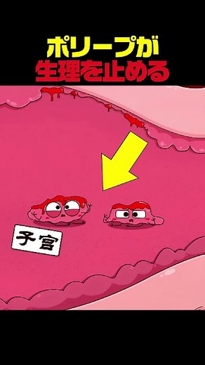 ポリープが生理に与える影響と対策