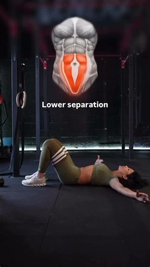 Which Type of Diastasis Recti Do You Have?🤔 || #core #postpartum #coreworkout #mom