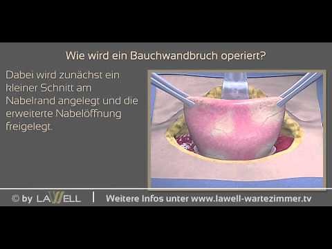 Ambulante Nabelbruchbehandlung bei Erwachsenen
