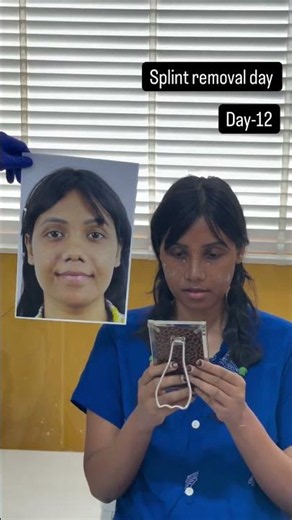 Rhinoplasty journey _ splint removal day