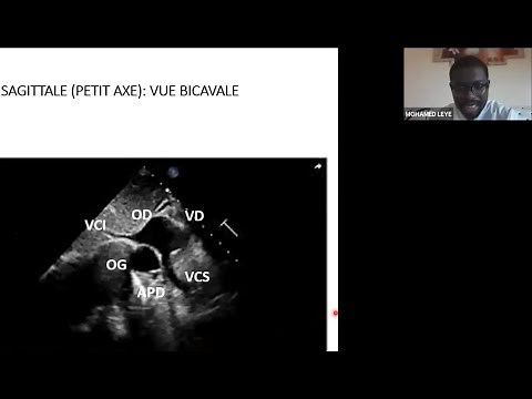 ECHOCARDIOGRAPHIE DES CARDIOPATHIES CONGENITALES: CONNAISSANCES DE BASE