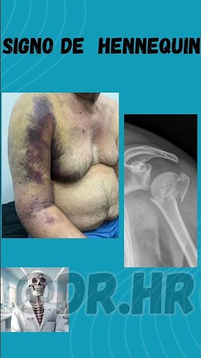 Signo de hennequin fractura de húmero #medico #medicina #estudiantesmedicina #semiologia #shorts