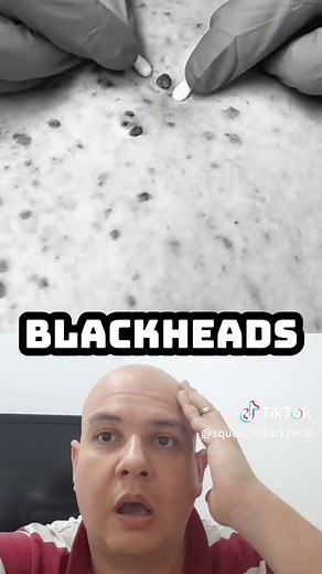 Blackheads, also known as comedones, are caused by the accumulation of sebum, dead cells and bacteria in the pores of the skin. The factors that can lead to the appearance of blackheads are: Excessive sebum production Changes in the quality of sebum, which becomes thicker Accumulation of dead cells Accumulation of bacteria Exposure to the sun Use of oily cosmetics Genetic factors Hormonal changes Use of steroid-based medications Health conditions such as PCOS (Polycystic Ovary Syndrome), PMS and
