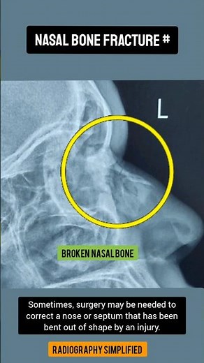 Broken Nose Explained: Causes, Symptoms, and Treatment #NasalFracture #ENT #radiology #HealthTips