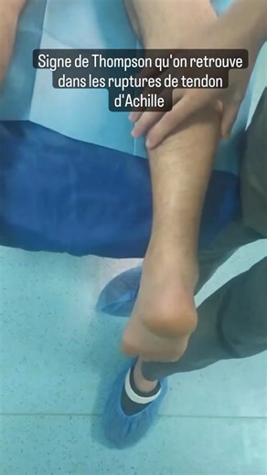 🎯 Le test de Thompson (en anglais calf squeeze test) 🔫 Test clinique simple et rapide utilisé pour rechercher une rupture complète du tendon d’Achille. Le patient est installé en décubitus ventral, avec les pieds dans le vide afin que la cheville soit libre. Les muscles du mollet doivent être relâchés. L’examinateur exerce ensuite une compression du mollet. Normalement, la pression du mollet entraîne automatiquement une flexion plantaire du pied, grâce à la transmission de la force via le tend