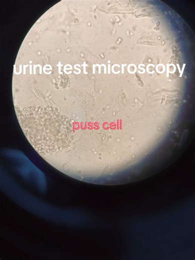 Understanding Urine Test Microscopy Results