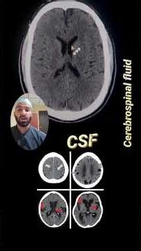 Ischemic brain stroke Pathologies #radiologyeducation #anatomy