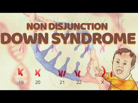 Down Syndrome - Nondisjunction | Chromosome 21 | Trisomy