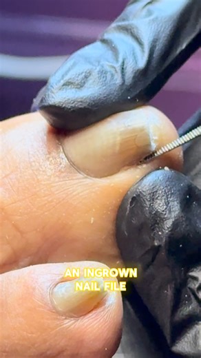 Angela Wiggesworth on Instagram: "If your clients come in wincing from an ingrown toenail, this is the tool that brings them instant relief — when used correctly. Today’s tutorial shows exactly how I use an ingrown toenail rasp to: ✨ Release pressure ✨ Smooth the offending corner ✨ Reduce irritation ✨ Help clients walk out feeling BETTER than they came This is the kind of restorative care that keeps clients returning again and again. And if you want to deliver that same level of comfort in your 