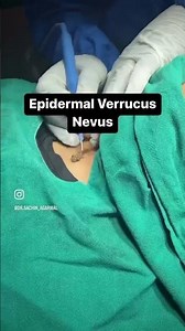 A verrucous epidermal nevus (VEN) is a skin disorder treated successfully with electrocautery #nevus