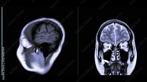 Comparison MRI of the brain sagittal and Coronal plane for detect a variety of conditions of the brain such as cysts, tumors, bleeding, swelling, developmental and structural abnormalities.