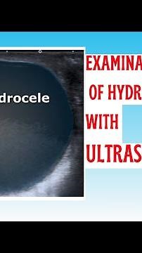 Hydrocele: How is it formed? Examination of hydrocele with ultrasonography #Hydrocele