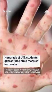 Hundreds of U.S. students quarantined amid measles outbreaks
