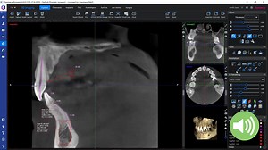 Making annotations in 3D module of Planmeca Romexis