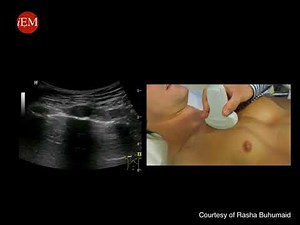 Video 12 Tutorial on lung ultrasound for pulmonary edema