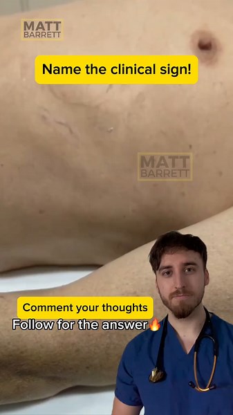 Understanding Hoover's Sign in COPD Patients