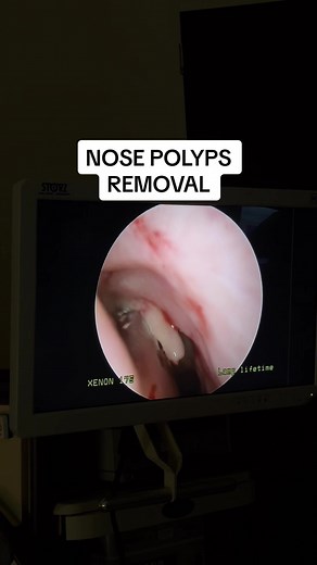 Nasal polyps 🦠👃 Removing a huge one in the OR today! #nasalpolyps #nosepolyps #polypsurgery #polypsremoved #breathebetter #drbreathebetternow #entsurgery #entsurgeon #nosesurgery
