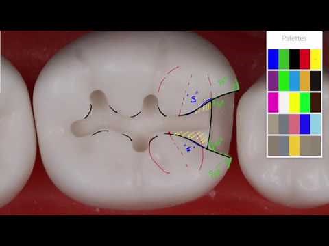 Class II Amalgam #19 MO Acadental | Amalgam Preparation Technique