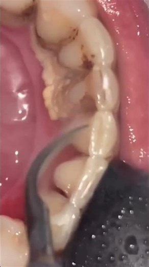 This Tartar Removal Is So Satisfying 🤯🦷
