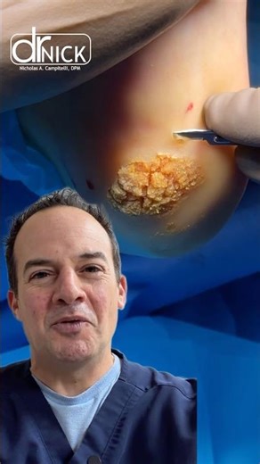 How to treat a plantar wart!!