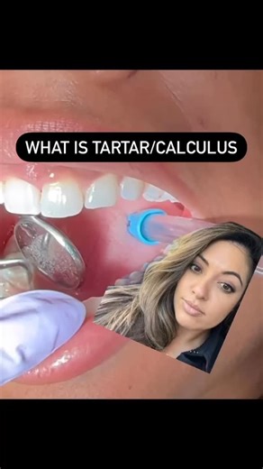 Dr. Ruhee Jaffer RDH, DDS on Instagram: "Tartar, also called dental calculus, is hardened plaque that forms on your teeth when soft plaque isn’t removed through regular brushing and flossing. • Plaque = soft, sticky bacteria film (can be removed at home) • Tartar = plaque that has hardened with minerals from saliva (cannot be removed at home) #dentistry #tartar #cosmeticdentistry #dentist #deepcleaning"