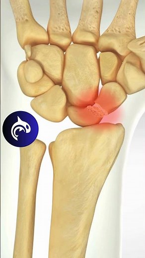 Scaphoid Fracture Surgery | 4K 3D Medical Animation