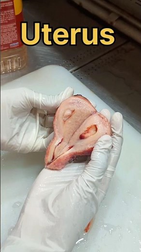 Uterus specimen cutting and grossing 🧐| #histopathology #uterinepolyp #endometrialpolyp #uterine