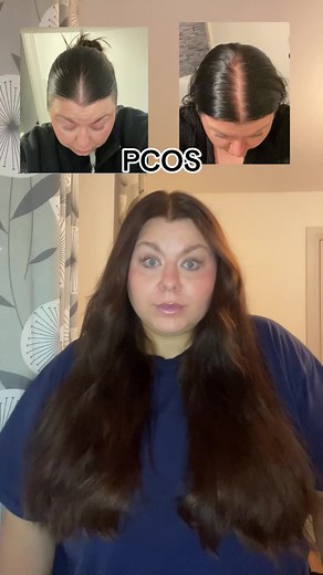 Understanding PCOS Related Hair Loss Solutions