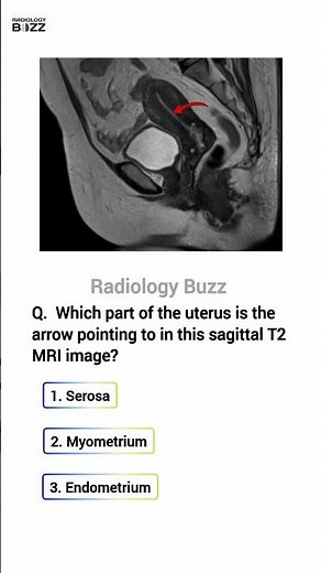 🩺MRI Quiz: Uterus Anatomy!🤔