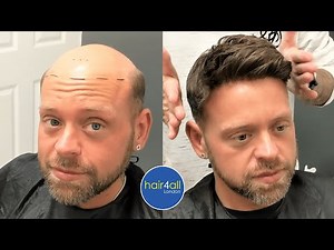 Before & After | Hair System | Non-Surgical Hair Replacement System Men/Women | UK/USA/International