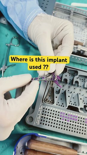 TITANIUM IMPLANTS !! HOW DO THEY LOOK #drprashanttripathi #hospital #doctor #orthopedicsurgeon