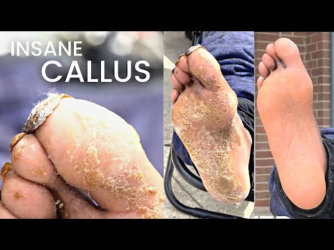 Callus Removal From Feet | Insane Pedicure