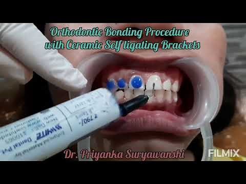 Braces/orthodontic bonding procedure with ceramic self ligating brackets