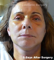 Facelift Recovery | Sunset Cosmetic Surgery