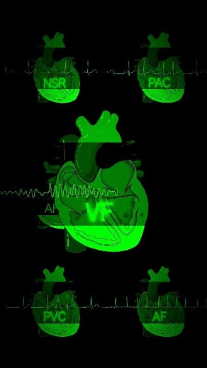 18K views · 178 reactions | Cardiac arrhythmia Visual: NSR, PAC, PVC, AF, and VF—Share this electrifying insight! 變 Credited; QQnursing. #CardiologyInsights #ECGMastery #HeartHealth #MedicalVisuals #CardiacRhythms #CardioProfessionals | Abdallah Othman | Facebook