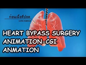 Heart bypass surgery || 3D CGI Animation || Medical Animation