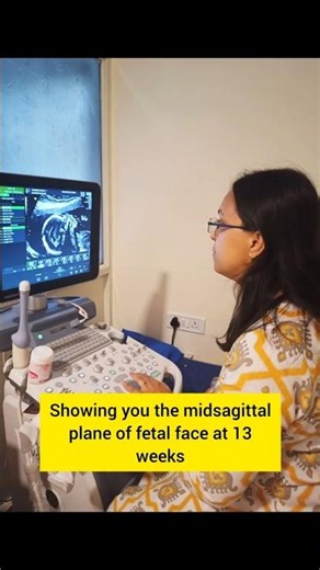 This tiny profile view at 13 weeks is more than just a cute picture #ntscan #fetalmedicine #pregnant