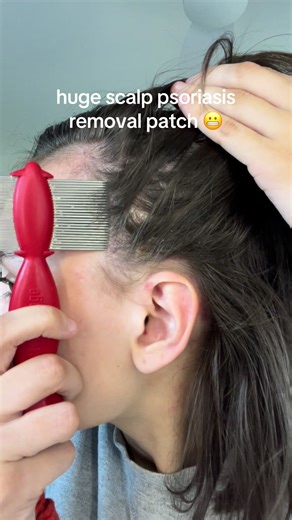 happy holidays !! its weird not having new content anymore but meh good news for me lol #psoriasis #scalppsoriasis #scalppsoriasisremoval #psoriasistok #psoriasishelp