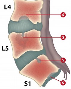 How to Fix Schmorl Nodes Easy And For Good - PostureInfoHub