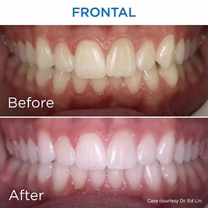 Class I and Class II crowding in 17-year old female patient. 4.25...