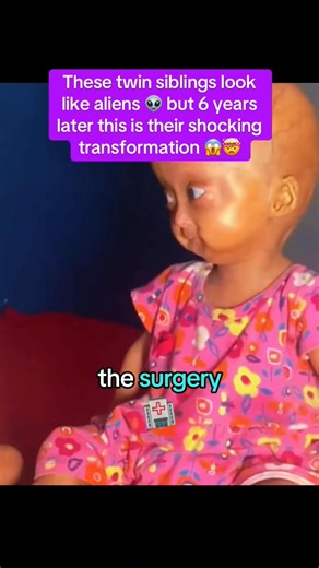 These twin siblings look like aliens but 6 years later this is their shocking transformation..😲😲😱😱😱 #fypviralシ #truestory #truth #realstory #fypシ゚viralシfypシ゚viralシalシ #foryou | Did you know ?