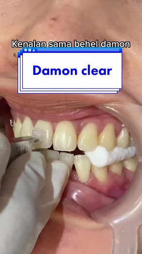 Kenalan sama behel damon clear yuk!