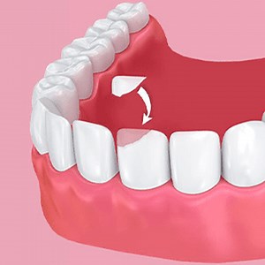 Dental Bonding - Cost for Composite Bonding in Mexico