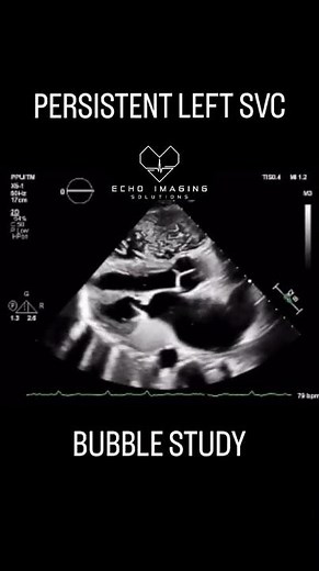 Ruling in a persistent left superior vena cava can be done by performing an agitated saline bubble s