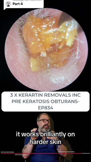 Keratosis Removal: Satisfying Ear Wax Cleaning Process
